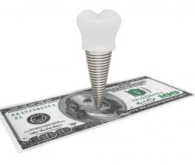 money for dental implant parts
