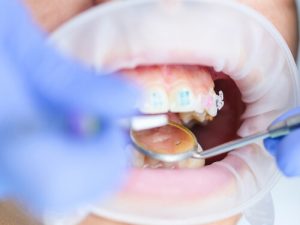 common dental procedures