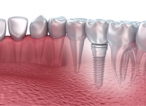 3d printed teeth implants