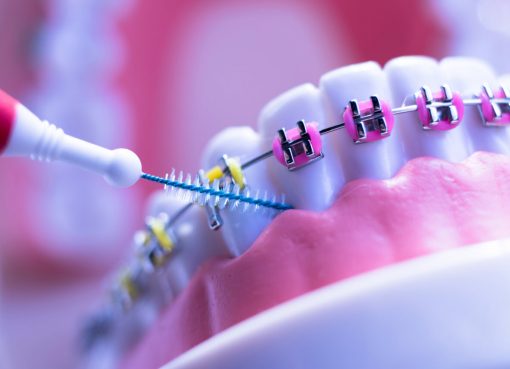 dental cleaning with braces