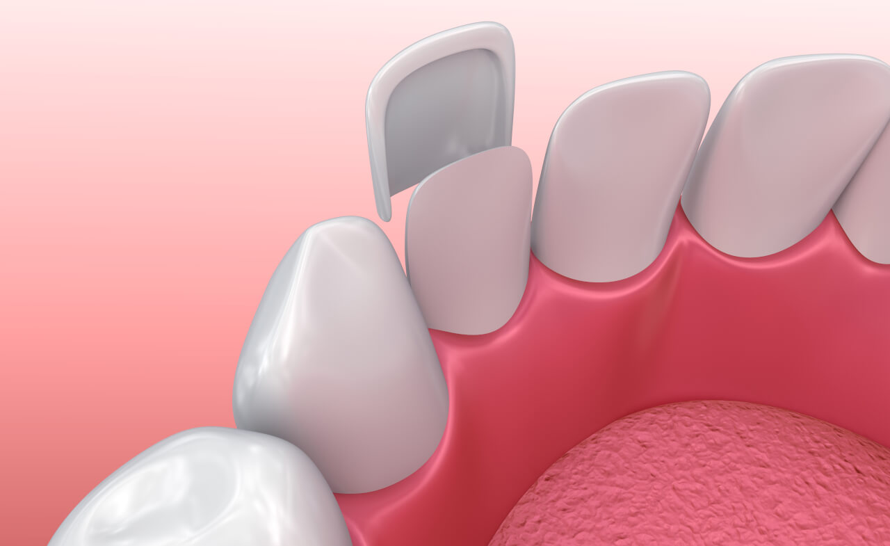 veneers teeth pros and cons