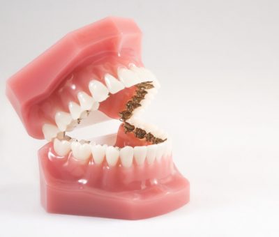 lingual orthodontic