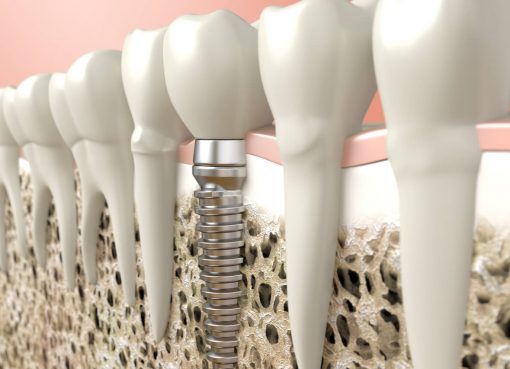 why do dental implants cost so much