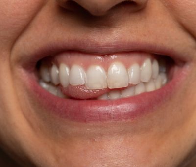 Steps On How To Treat Receding Gums