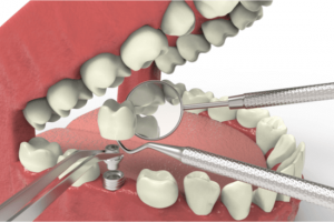 placing dental implants
